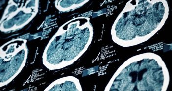 How to Minimize Stroke Risk