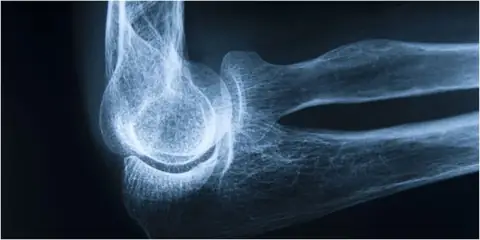 Six Practices That Could Lead To Poor Bone Health
