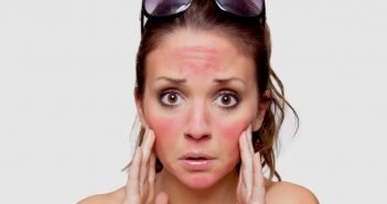 Tips And Tricks: Quick Ways To Treat Sunburns